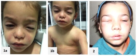 Figura 1a e 1b - Angioedema por alergia a amoxicilina/ácido clavulânico
Figura 2 - Angioedema hereditário