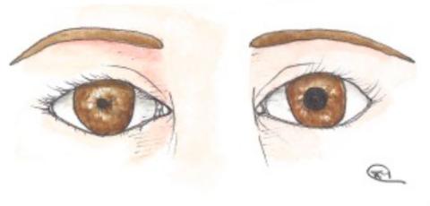 Figura 1. Anisocória, com pupila do olho esquerdo maior do que do olho direito
