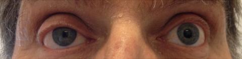 Figura 8. Síndrome de Horner esquerdo, com pupila miótica (não dilata como habitualmente) e ptose palpebral