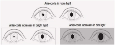 Figura 4. Lado esquerdo: a anisocória é mais evidente em condições de luz, pelo que a lesão está do lado esquerdo (a pupila deveria ser mais pequena); lado direito: anisocória mais evidente na escuridão, pelo que a lesão está do lado direito (a pupila deveria ser maior)