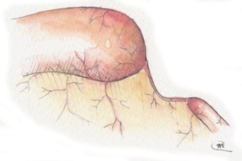 Atrésia intestinal