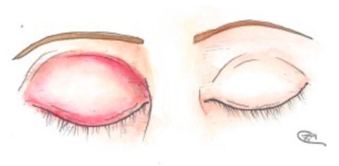 Celulite Pré-Septal (Periorbitária): o que é, como diagnosticar e tratar