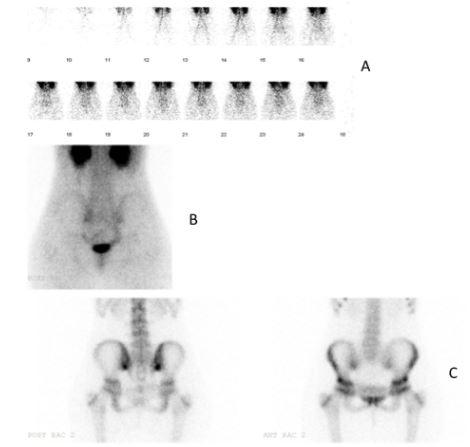 Fig. 1 - Cintigrafia óssea em 3 fases [A-vascularização; B-distribuição intersticial; C-distribuição óssea]
