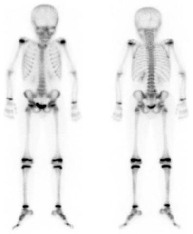 Fig. 2 - Cintigrafia óssea de corpo inteiro
[Imagem amavelmente cedida pelo Serviço de Medicina Nuclear do Centro Hospitalar e Universitário de Coimbra]