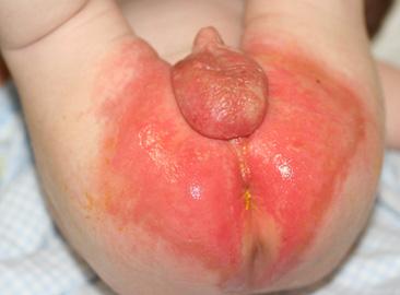 Dermatite da área da fralda - lesões húmidas (infecção por Candida albicans)