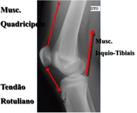 Doença de Osgood-Schlatter 