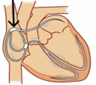 Nódulo sinusal: local onde é gerado o estímulo eléctrico no coração em condições normais.