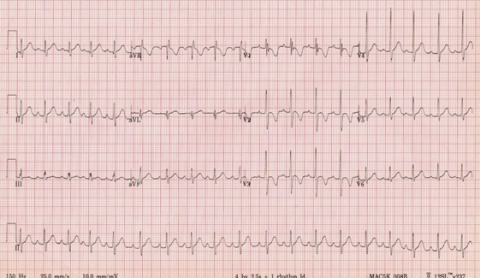 Exemplo de um traçado de ECG normal em criança de 8 Anos.