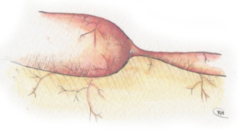 Estenose intestinal