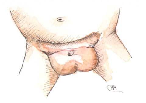 Hérnia inguinal bilateral