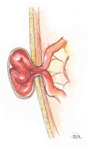 Hernia umbilical engasgada