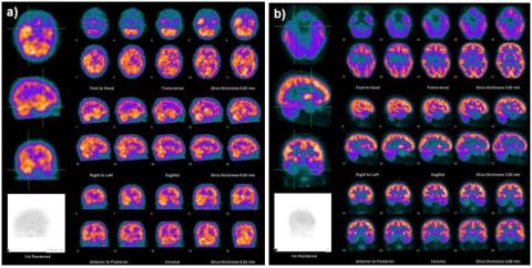 Figura 1 – a) SPECT de perfusão ictal e b) PET com 18F-FDG de criança do sexo masculino, com 10 anos de idade e com crises parciais complexas de início cerca de 6 meses antes. Restantes exames (EEG ictal e inter-ictal, RMN) e clínica apoiam o diagnóstico de uma Epilepsia Temporal Direita.
[Imagens cortesia do Serviço de Medicina Nuclear do CHUC]