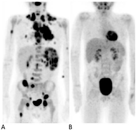 Figura 1 - Exames PET/CT com 18F-FDG em criança do sexo masculino, com 8 anos de idade. A – Avaliação inicial:  linfoma com envolvimento ganglionar cervical, supraclavicular, mediastínico, peri-esofágico, celíaco, dos hilos hepático e esplénico, lombo-aórtico, das cadeias ilíacas externas e inguinal e com múltiplas lesões pulmonares, ósseas e esplénicas. B – Avaliação de resposta após tratamento – sem alterações que possam sugerir persistência de linfoma, traduzindo resposta metabólica completa