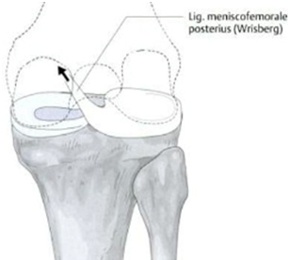 Tipo Wrisberg-ligamentar (‘Rupp 2000’)