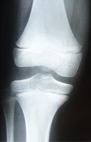 Rx Joelho direito AP com aumento do espaço articular externo e achatamento do côndilo femoral externo