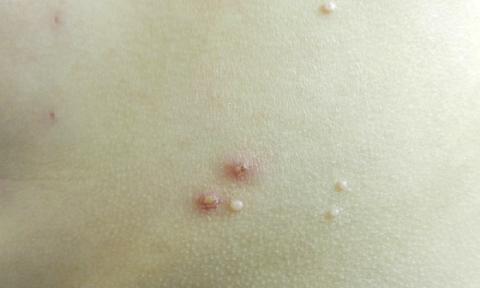 Lesões de molusco contagioso no tronco de uma criança