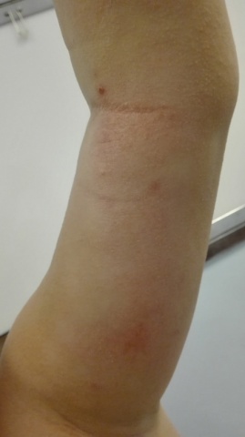 Molusco contagioso numa criança com dermite atópica