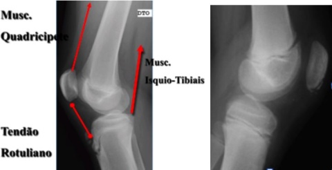 Osgood-Schlatter e Sinding-Larson-Johansson