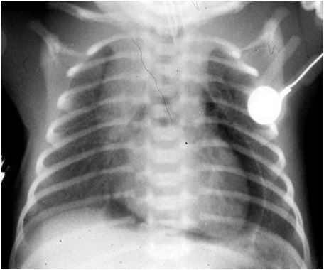 Figura 8 – Pneumopericardio