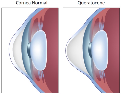 Figura 1: Esquema de comparação da córnea normal com queratocone