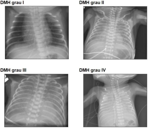 Radiografia de tórax no recém-nascido