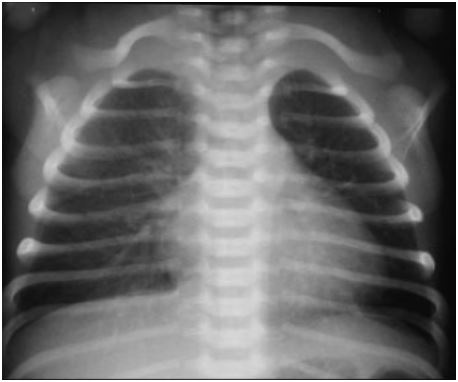 INFLUÊNCIA PULMONAR NO MODO DE NASCIMENTO DE NEONATAIS: UMA