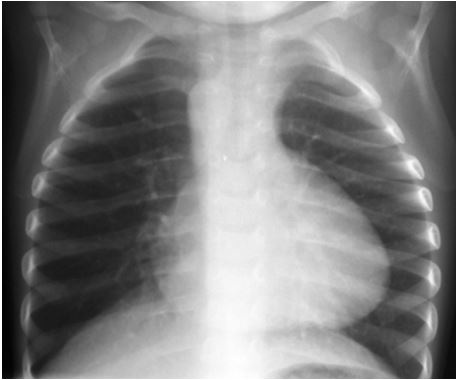 Figura 10 – Tetralogia de Fallot