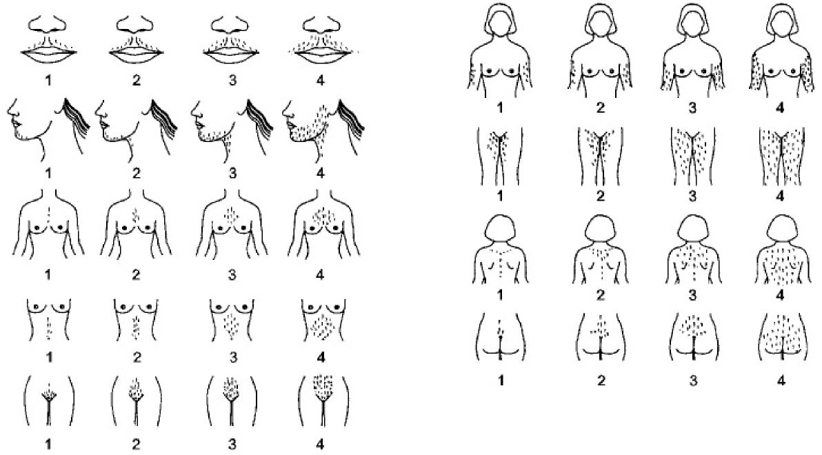 Hirsutismo | Pedipedia - Enciclopédia Pediátrica Online